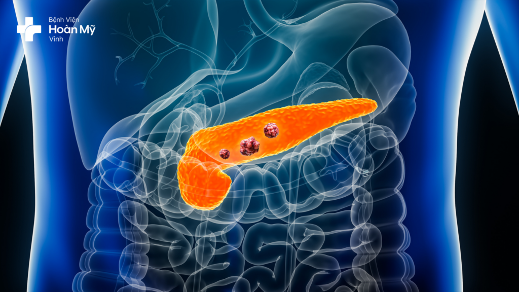 Viêm tuỵ cấp do tăng triglyceride
