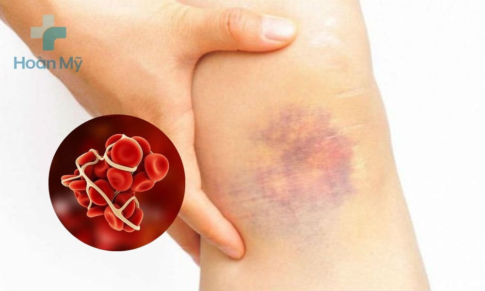 Vết bầm tím do rối loạn đông máu