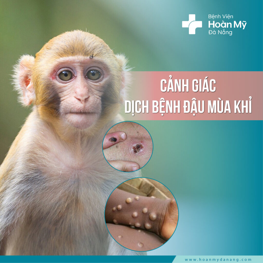 Cảnh giác với dịch bệnh đậu mùa khỉ