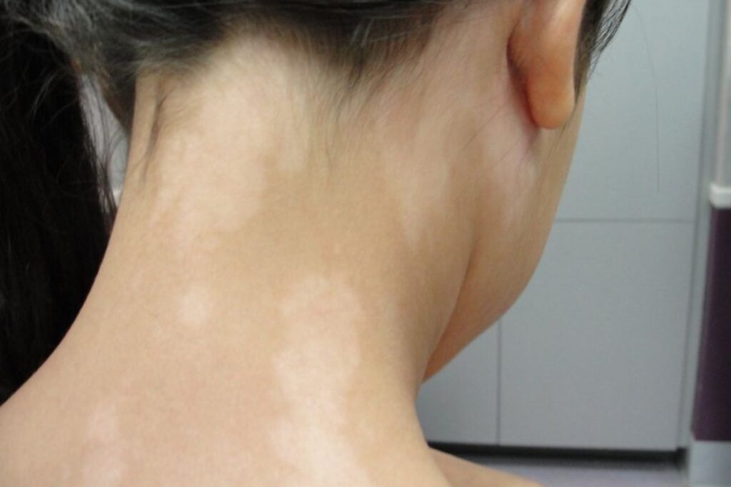 Bệnh lang ben làm mất thẩm mỹ và khiến bạn tự ti