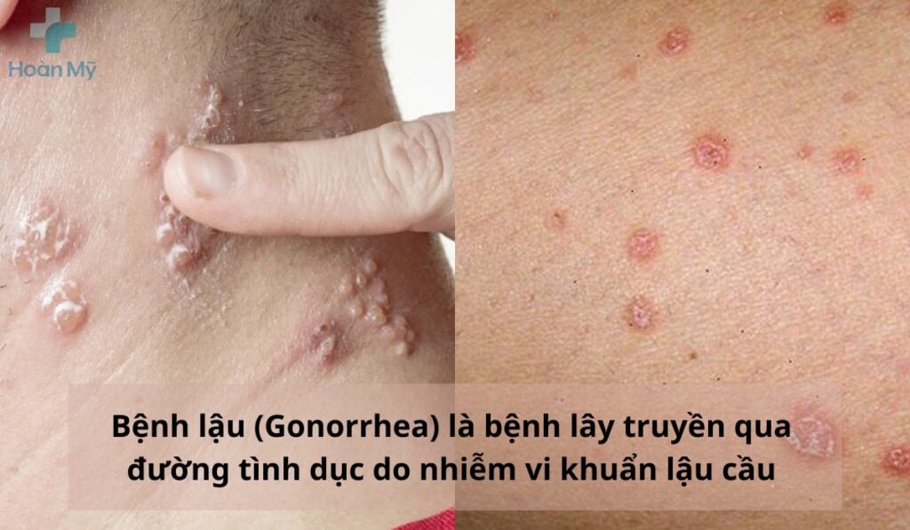 Vi khuẩn lậu cầu gây ra bệnh lậu ở cả nam và nữ 