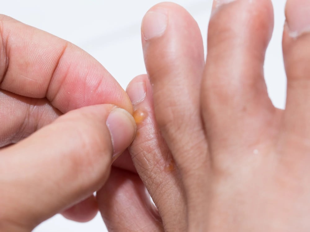 Phân loại bệnh chàm tổ đỉa