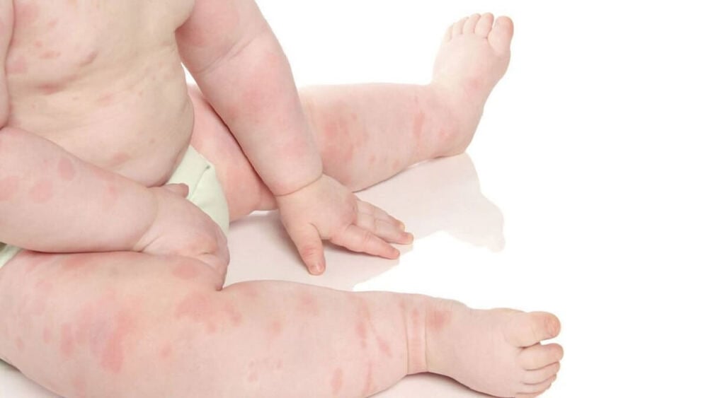 Bị vảy nến nặng có thể gây ra nhiều biến chứng khó lường