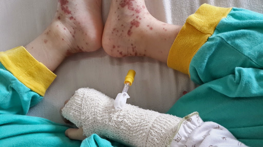 Biến chứng của bệnh viêm mao mạch dị ứng