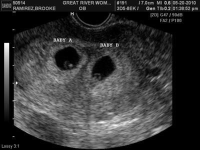 erternal Twins Ultrasound