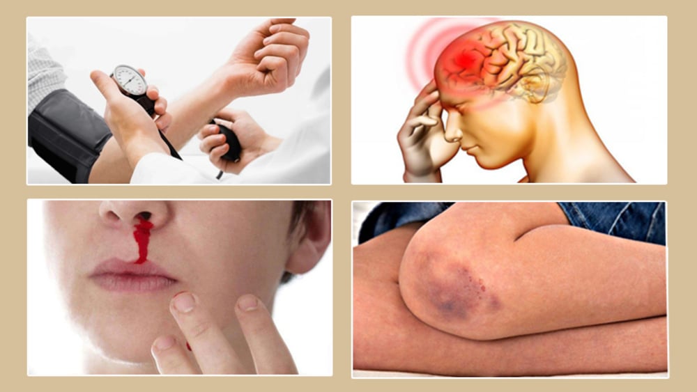 Các triệu chứng nguy hiểm của sốt xuất huyết