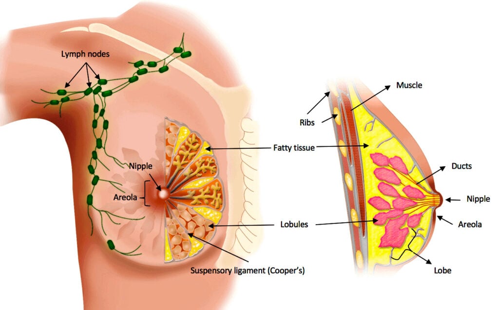 Các loại ung thư vú thường gặp