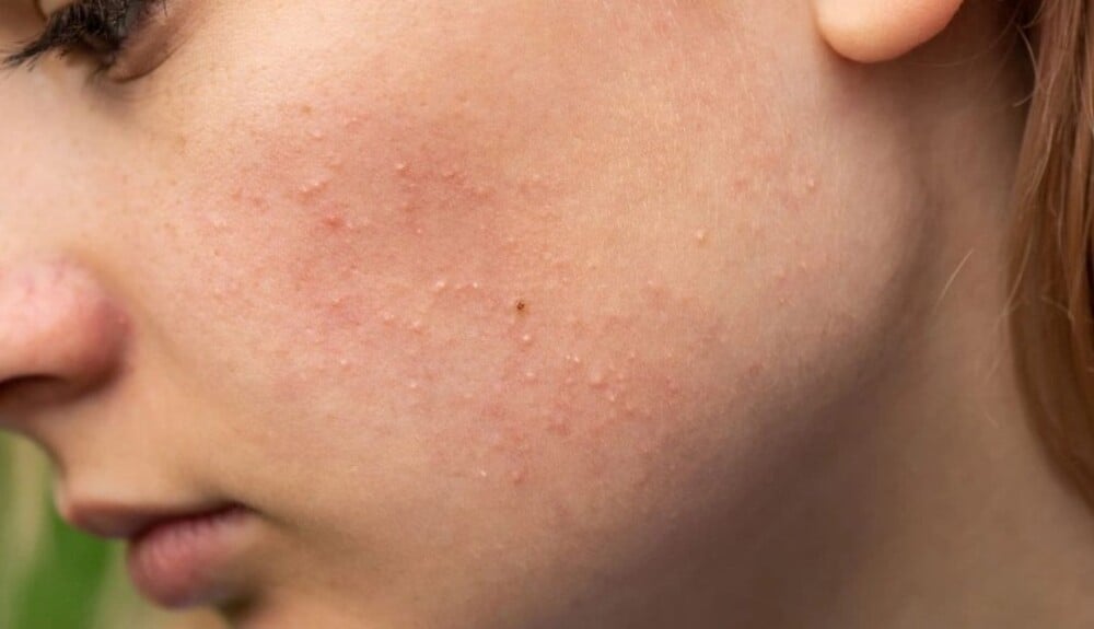 Vùng má, trán dễ nổi mụn dưới da