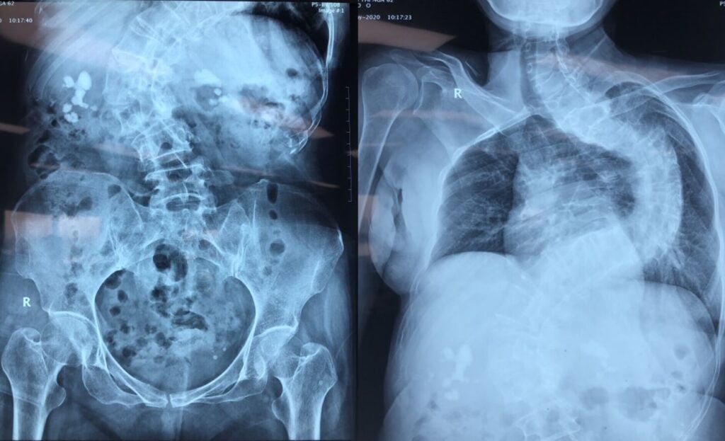 Chẩn đoán bệnh sỏi thận