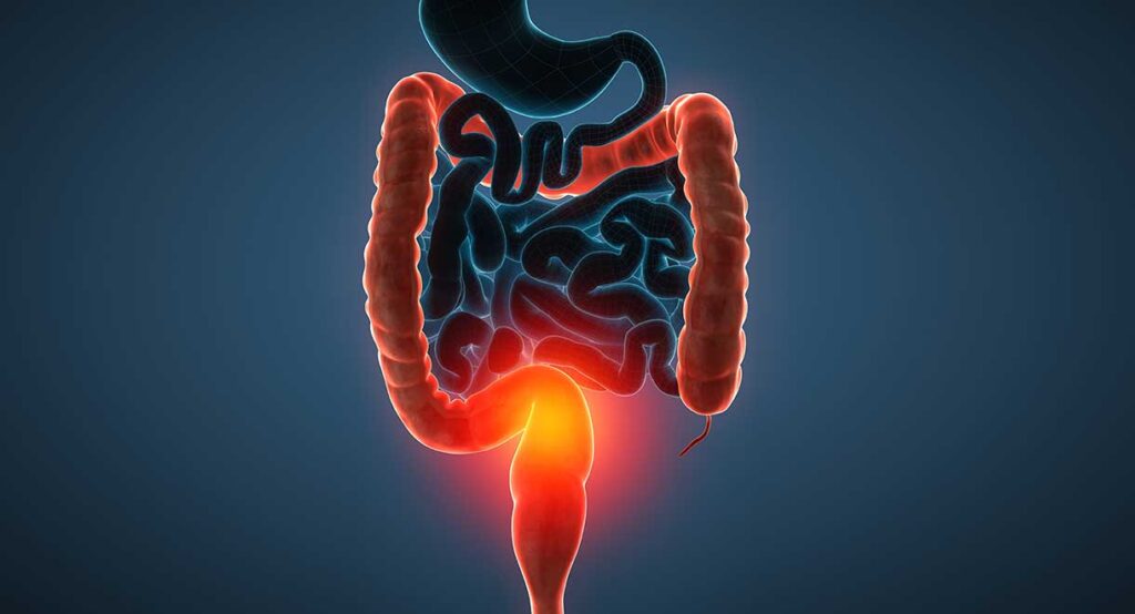 Cúc giáp cũng có khả năng giảm triệu chứng của bệnh viêm đại tràng cấp tính