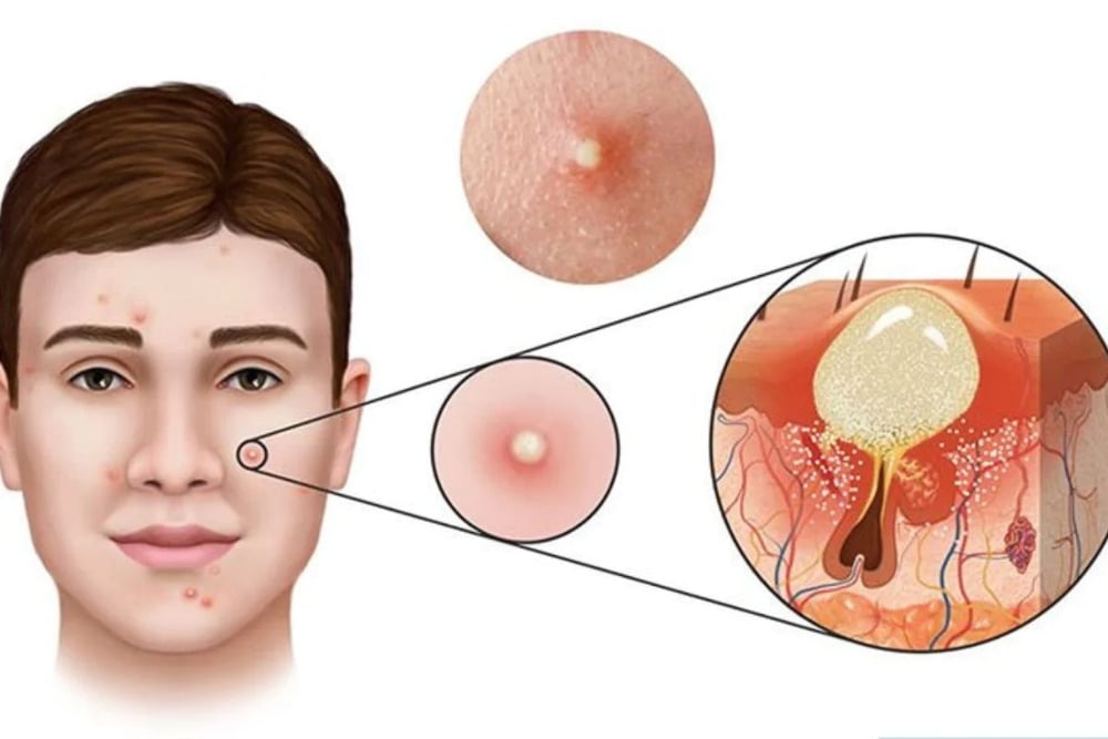 Nguyên nhân mụn bị viêm