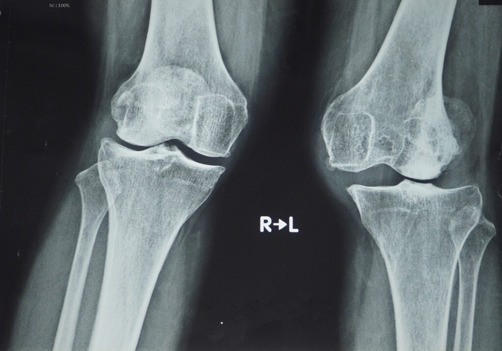 Chẩn đoán thoái hóa khớp gối