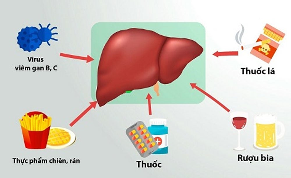 Những nguyên nhân làm tăng chỉ số men gan