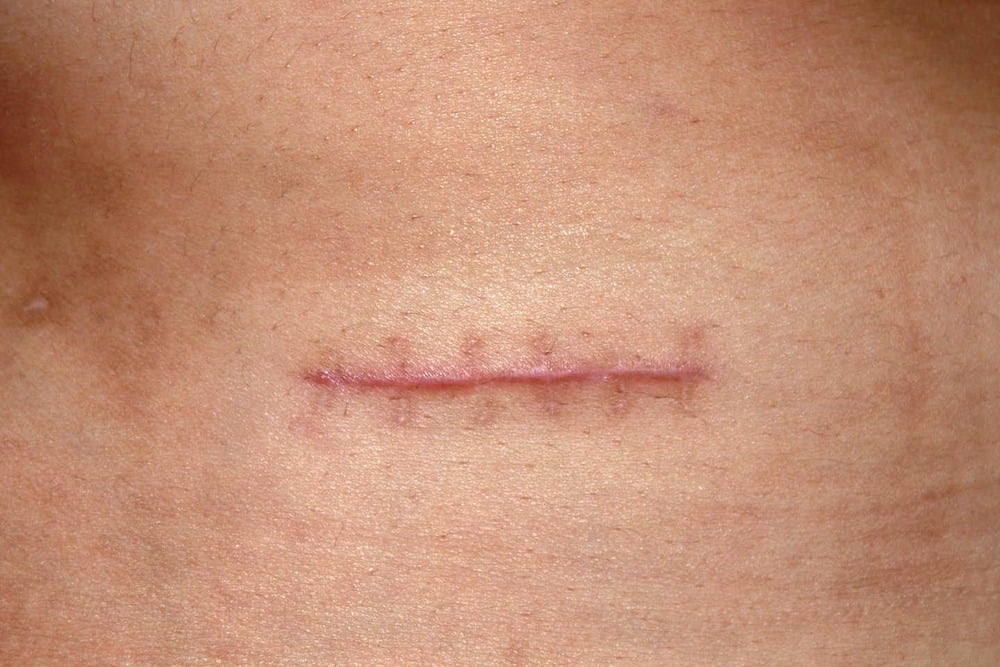 Thuốc trị sẹo Contractubex trị các sẹo do vết cắt gây ra