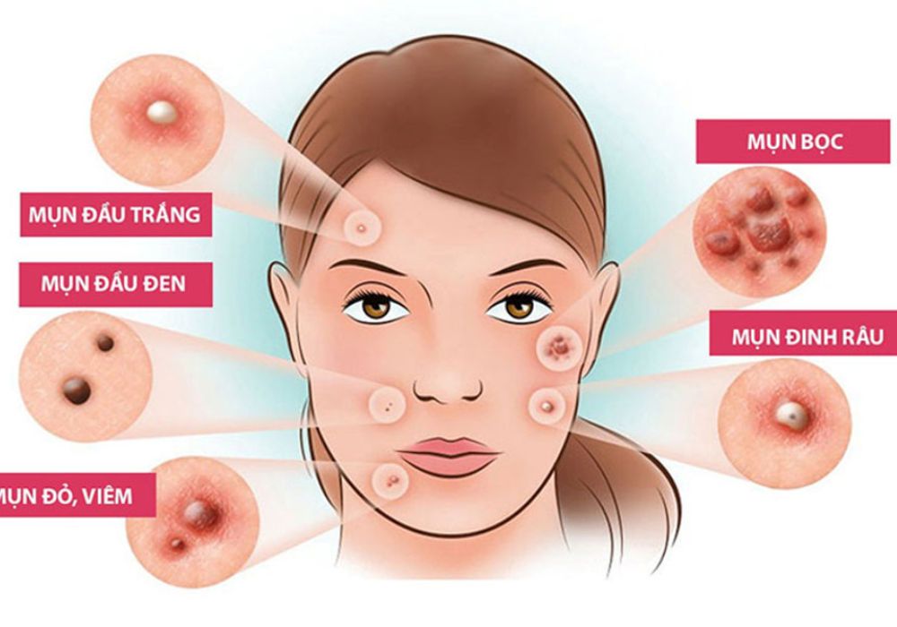 Dấu hiệu mọc các loại mụn