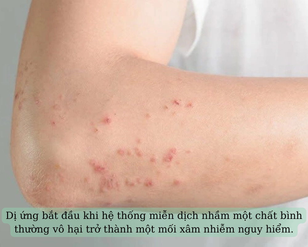 Dị ứng xảy ra khi hệ thống miễn dịch nhần lẫn các chất vô hại thành có hại