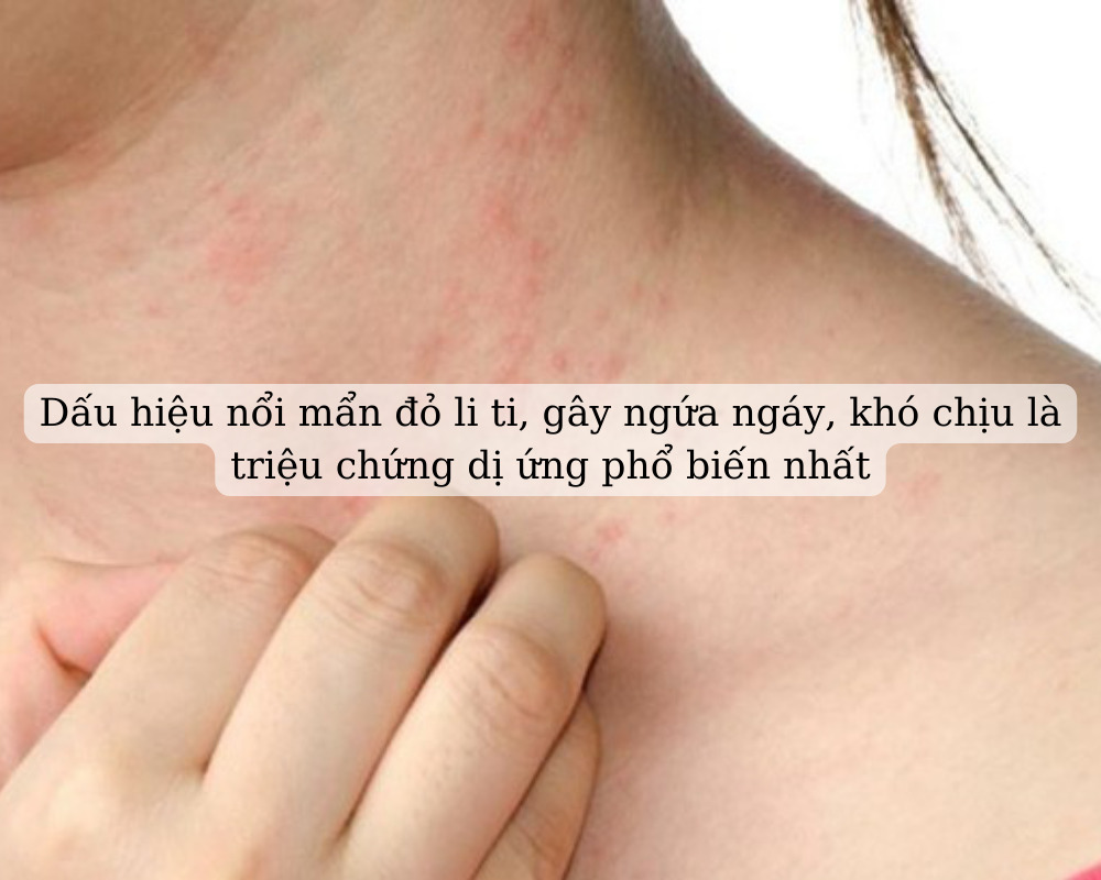 Dấu hiệu khi bị dị ứng