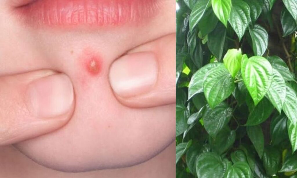 Lá lốt có thể dùng để chữa trị mụn nhọt 