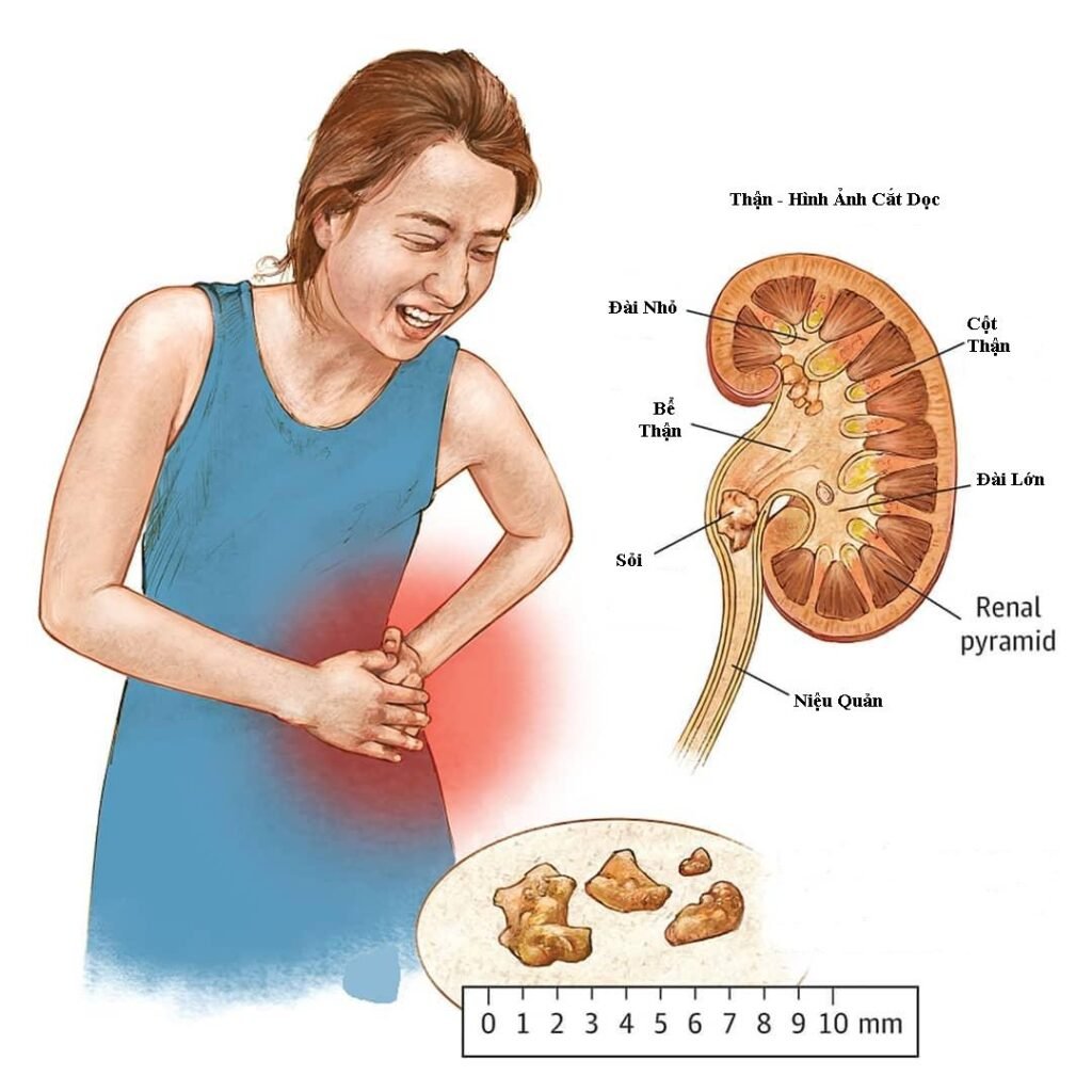 Đối tượng mắc bệnh sỏi thận