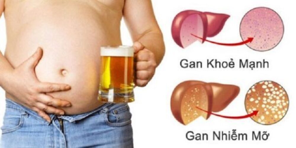 Nguyên nhân gây bệnh gan nhiễm mỡ cấp độ 1
