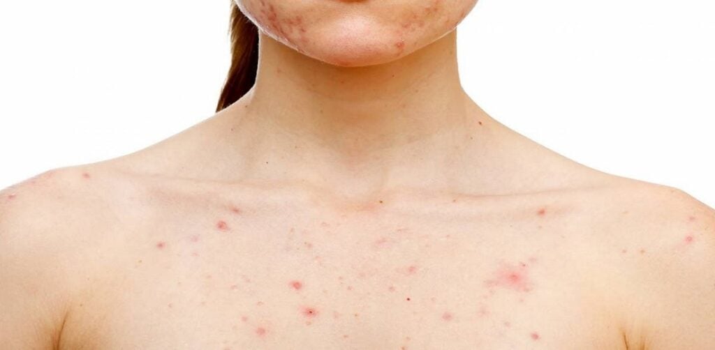 Gây nổi mề đay trên da 