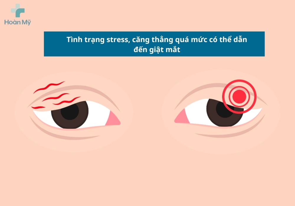 Mắt giật cảnh báo tình trạng mệt mỏi, căng thẳng