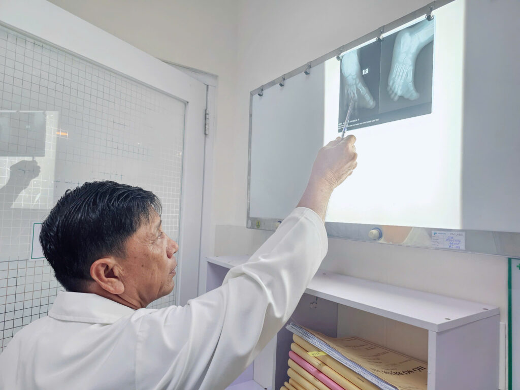 Điều trị sớm bệnh phì đại ngón chân cái giúp trẻ hết đau, đi lại bình thường