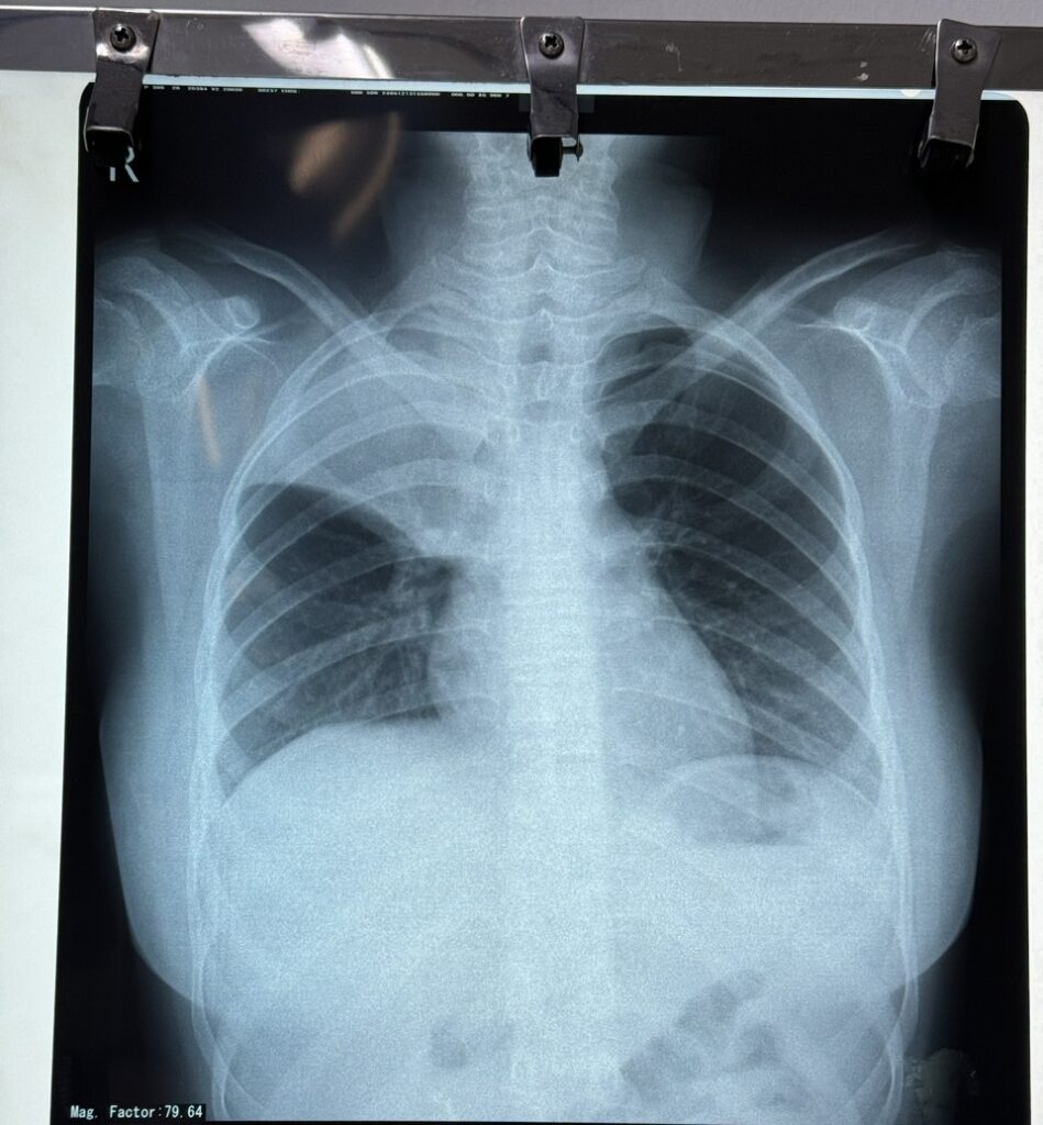 Nguy hiểm bệnh lý viêm phổi thuỳ ở trẻ em