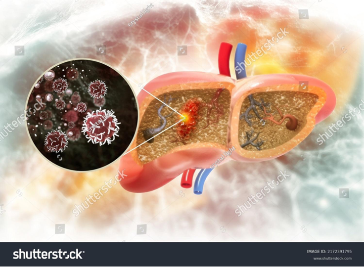 Ung thư gan: Một trong những bệnh lý ác tính có tỷ lệ gây tử vong hàng đầu Việt Nam