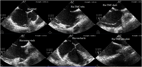Siêu âm tim qua thực quản trong can thiệp tim bẩm sinh 