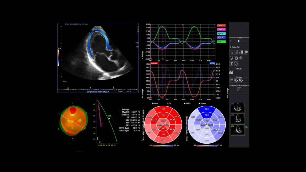 Siêu âm tim đánh dấu mô