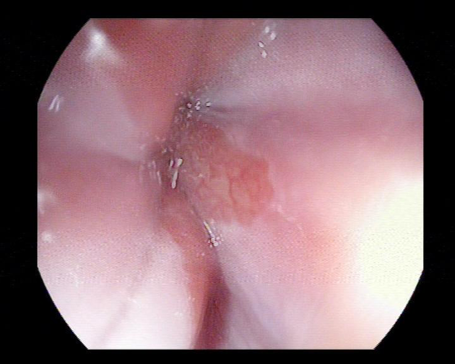 Hình ảnh Barret thực quản đoạn ngắn
                   