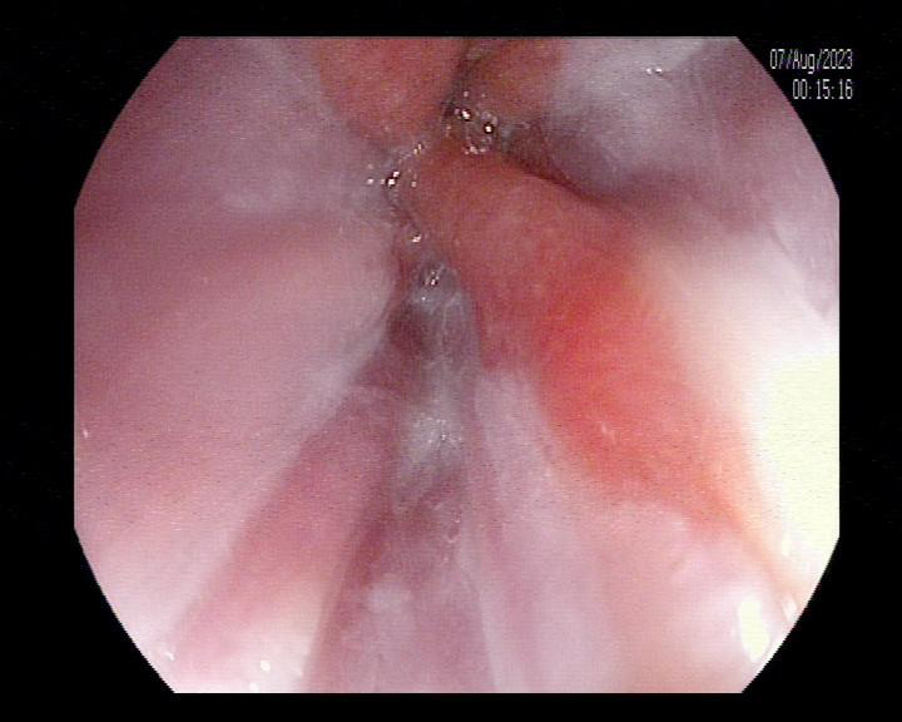 Hình ảnh Barret thực quản phát triển từ viêm trào ngược