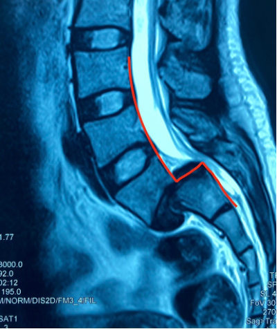 Bệnh Viện Hoàn Mỹ ITO Đồng Nai phẫu thuật thành công cho người bệnh trượt thân sống độ IV – Mức độ tổn thương nghiêm trọng
