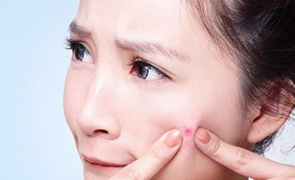 Nặn mụn là nguyên nhân dẫn đến thâm mụn