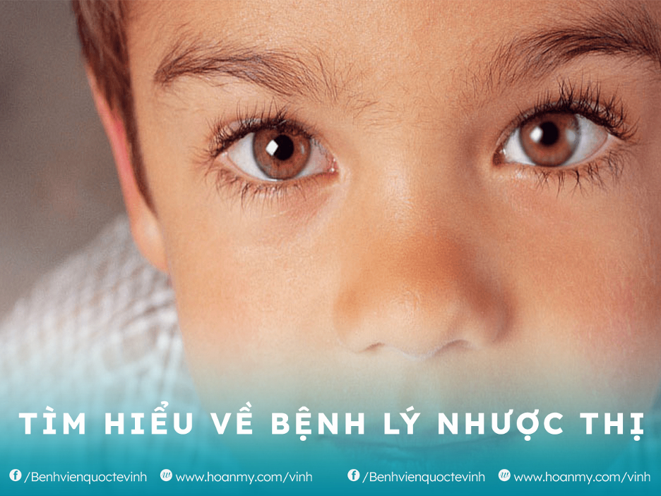 Tìm hiểu về bệnh lý nhược thị