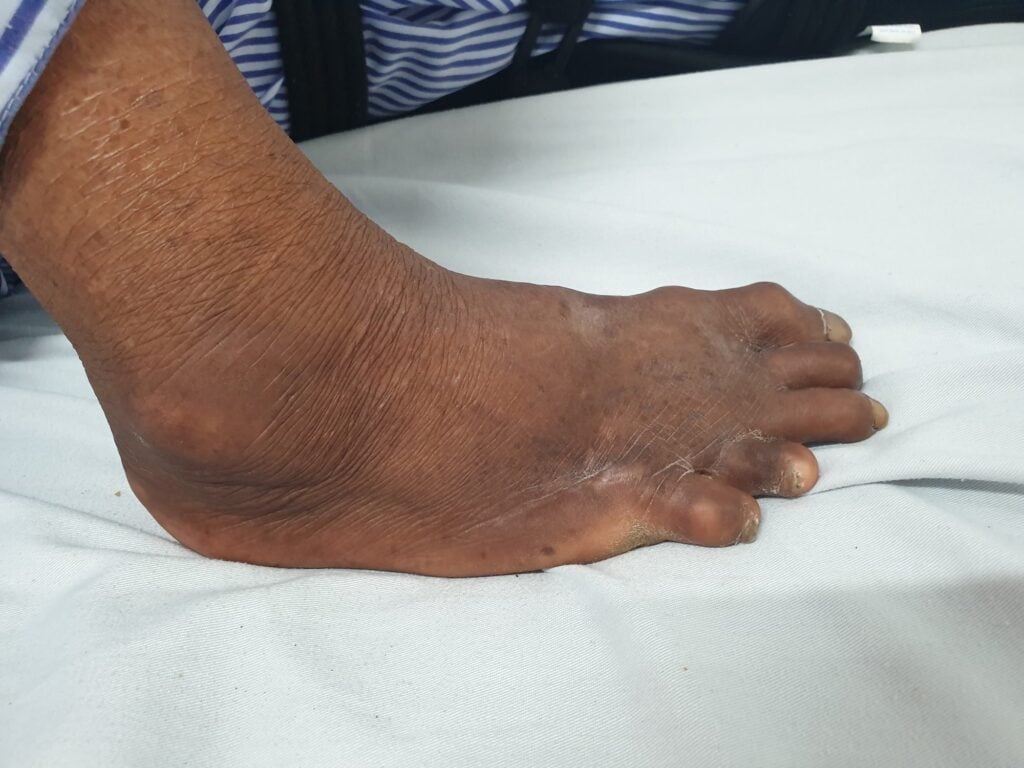 Bệnh phong: Đặc điểm, nguyên nhân, dấu hiệu và cách điều trị