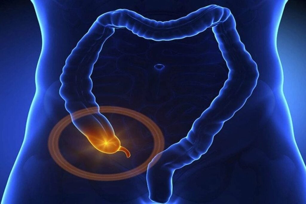 Trong ruột thừa có khối u 