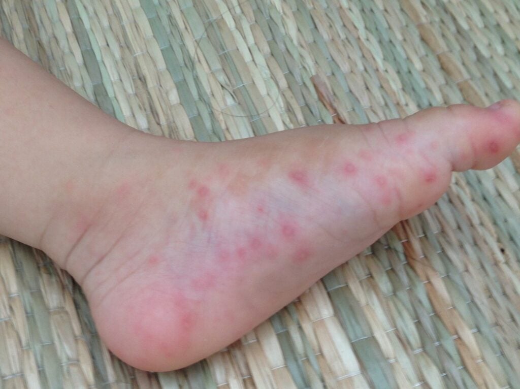 Nốt ban ít xuất hiện hơn 