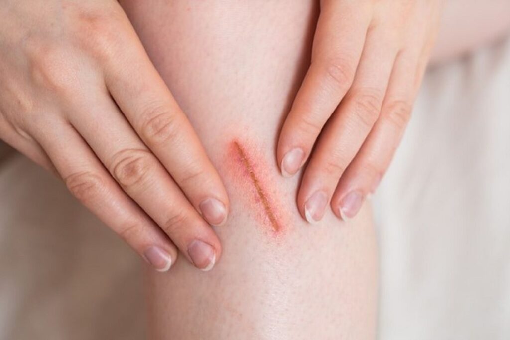 Vitamin C giúp làm lành vết thương 