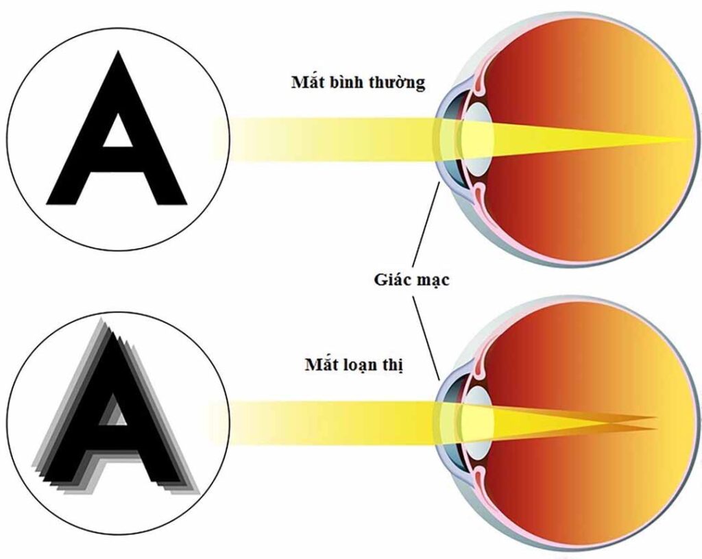 Loạn thị là gì? Nguyên nhân, triệu chứng & cách điều trị