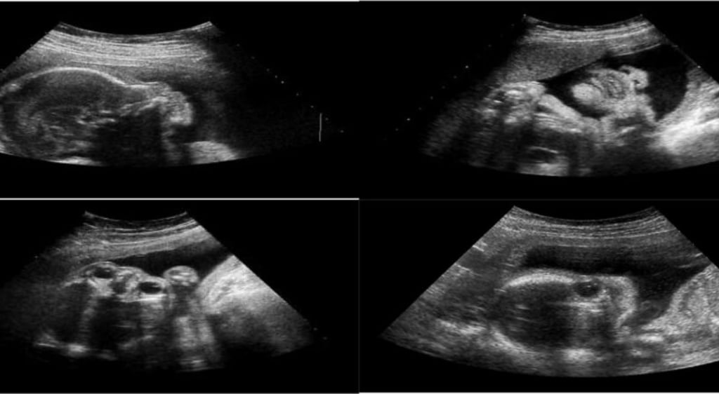 Siêu âm giúp mẹ bầu theo dõi quá trình phát triển của con