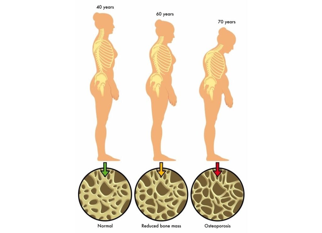Mật độ xương giảm dấu hiệu chuyển tiếp mãn kinh