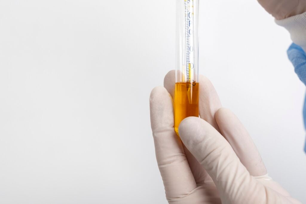 Màu nước tiểu thay đổi 