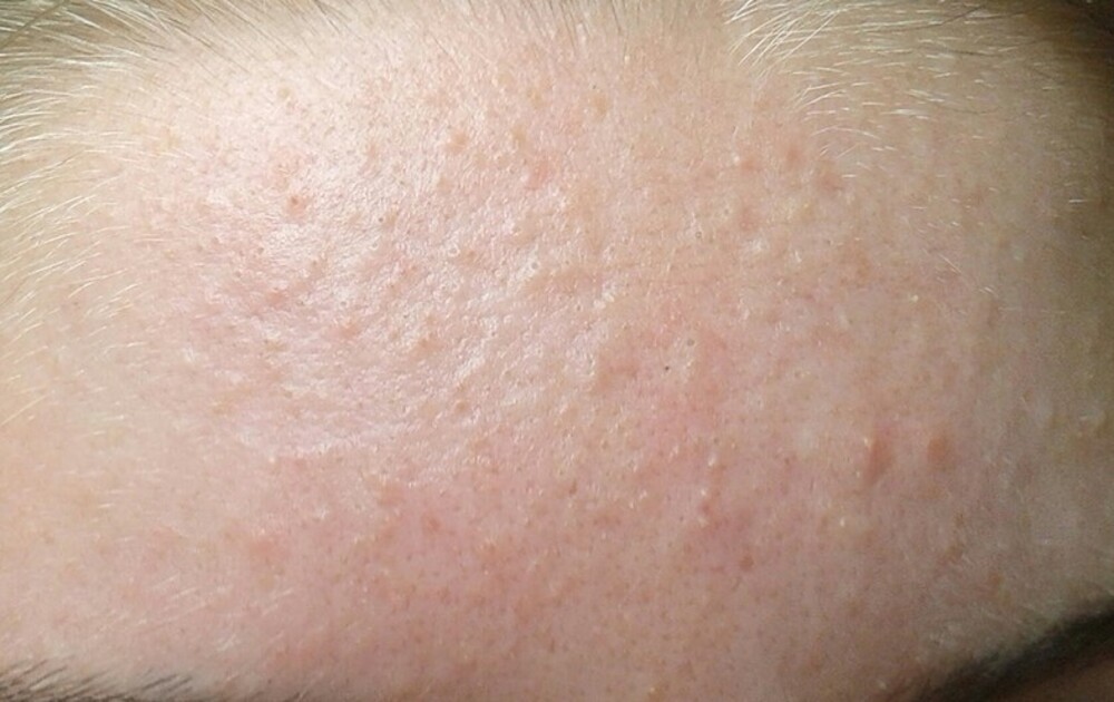 Mụn ẩn nằm dưới da