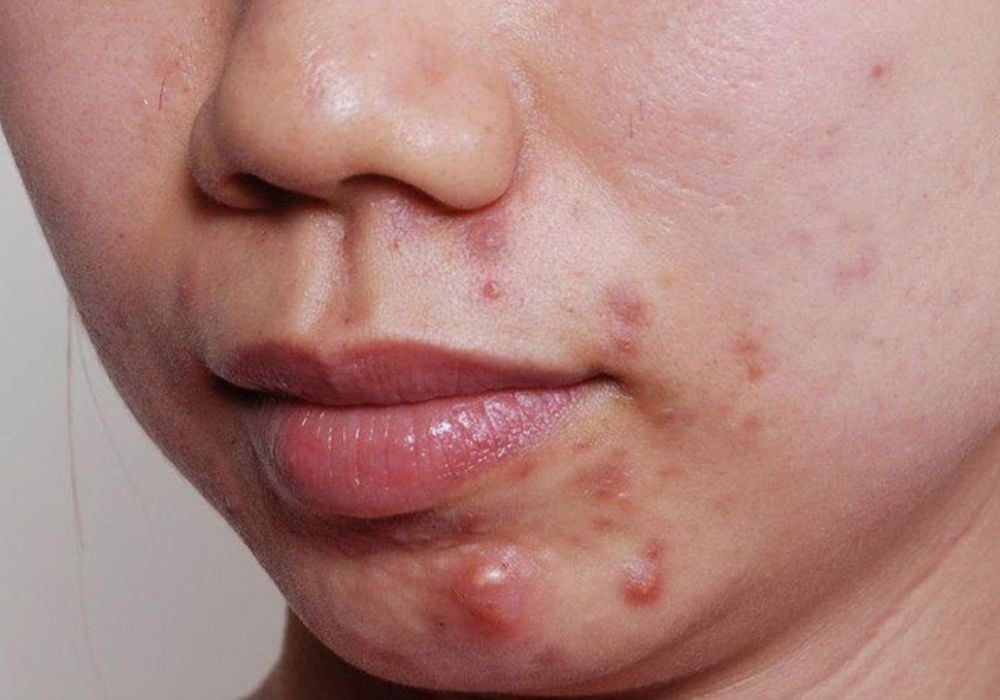 Không nên tự ý nặn mụn bọc