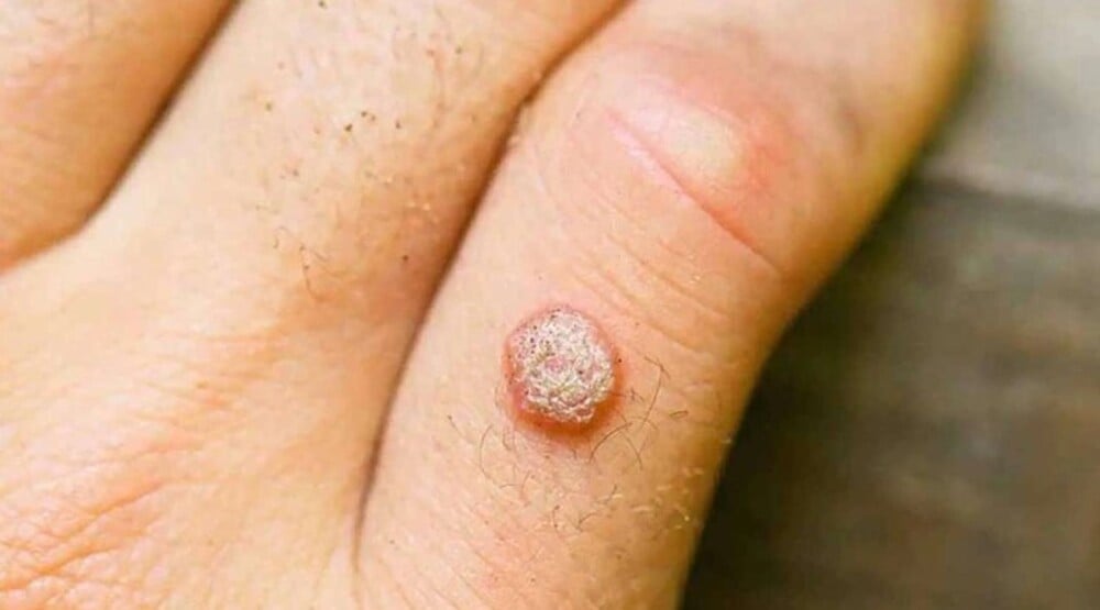 Các loại mụn khác: mụn cóc