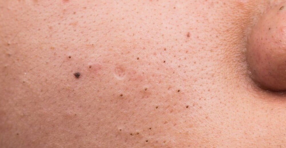 Mụn đầu đen trên da