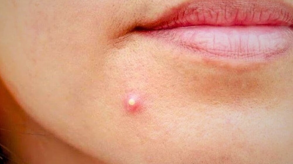 Mụn nhọt chứa mủ