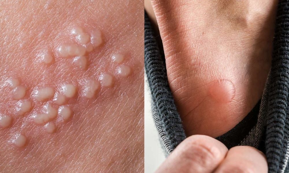 Mụn nước có thể biến mất sau vài ngày